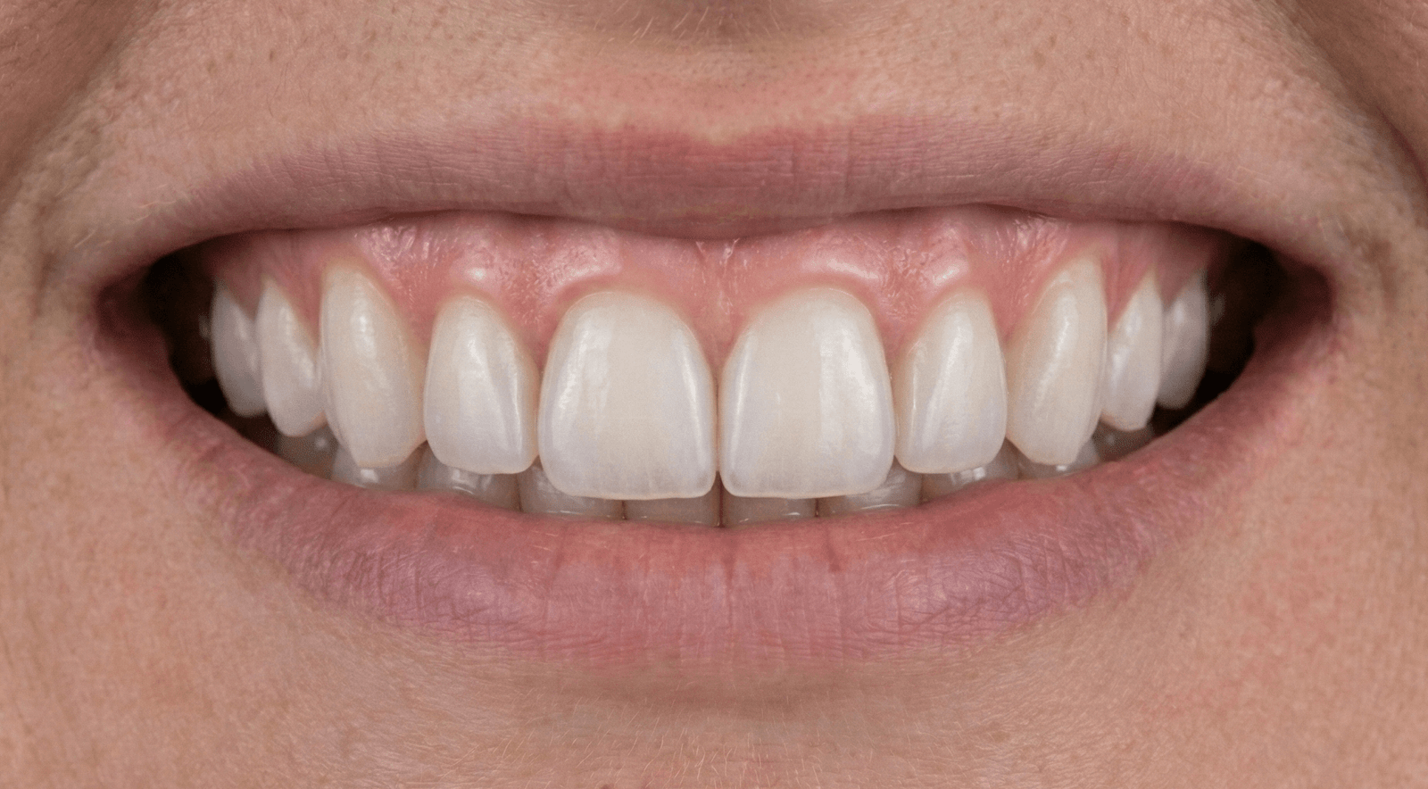 Carillas de Porcelana