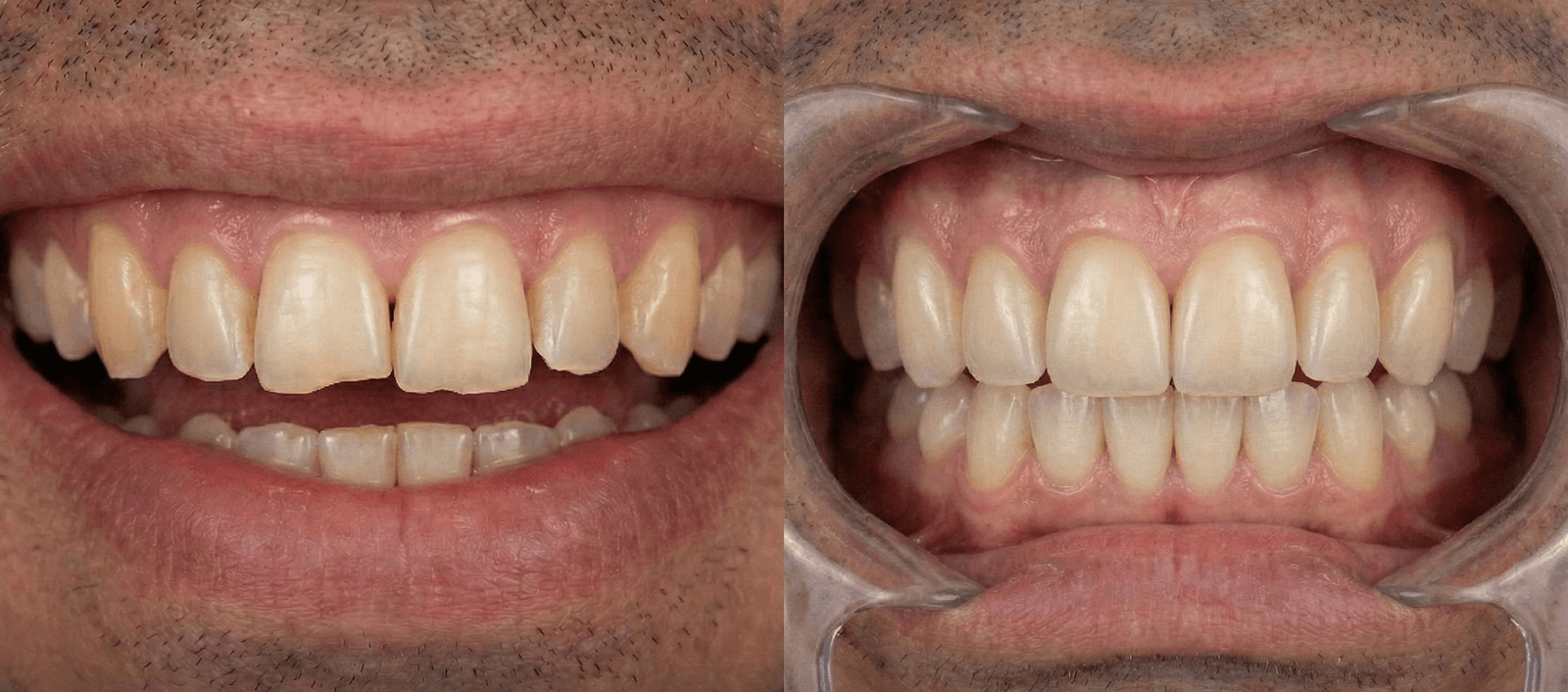 Carillas de Resina Inyectada